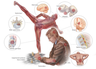 BRAIN INJURY CONCUSSION SPORTS INJURY WHIPLASH  BRAIN / SPINE TUMOR STROKE ARTHRITIS / JOINT INJURY SPINAL CORD INJURY CARPAL TUNNEL SYNDROME NERVE IRRITATION TENNIS ELBOW BONA KIRN BACK PAIN logo