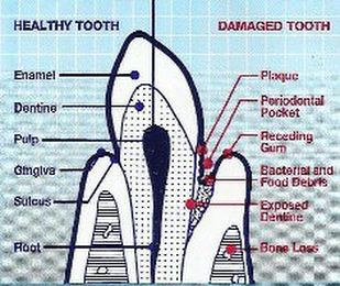 HEALTHY TOOTH DAMAGED TOOTH ENAMEL DENTINE PULP GINGIVA SULCUS ROOT PLAGUE PERIODONTAL POCKET RECEDING GUM BACTERIAL AND FOOD DEBRIS EXPOSED DENTINE BONE LOSS logo